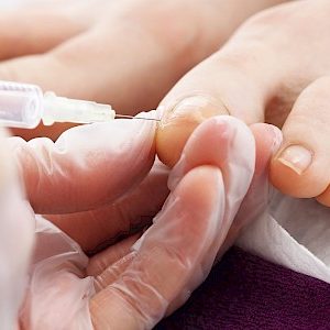 Cirurgia-de-unha
