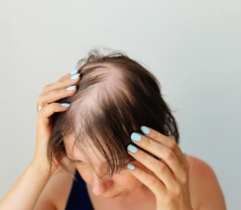 alopecia_aereata