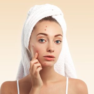 Close up isolated portrait of beautiful young Caucasian woman with blue eyes and problem skin, looking at the camera, pointing at pimple wearing white towel on her head against blue studio background Close up isolated portrait of beautiful young Caucasian woman with blue eyes and problem skin, looking at the camera, pointing at pimple wearing white towel on her head against blue studio background