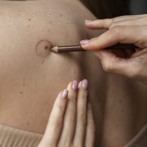 female-doctor-diagnosing-melanoma-body-female-patient (1)