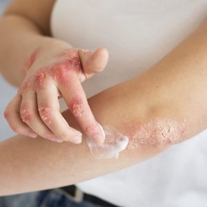 hands-patient-suffering-from-psoriasis hands-patient-suffering-from-psoriasis