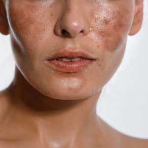 melasma melasma