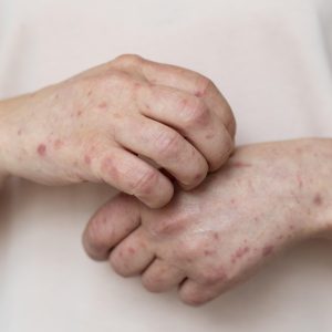 skin-allergy-person-s-arm skin-allergy-person-s-arm