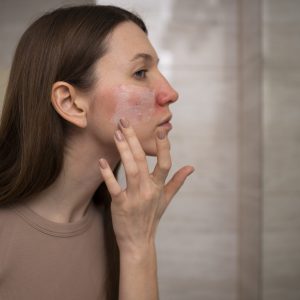 woman-using-moisturizer-help-with-rosacea-skin-condition woman-using-moisturizer-help-with-rosacea-skin-condition